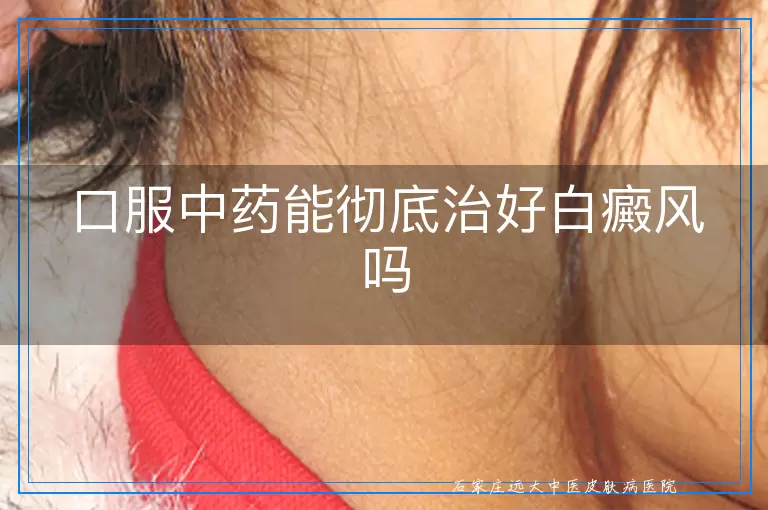 口服中药能彻底治好白癜风吗