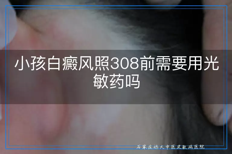小孩白癜风照308前需要用光敏药吗