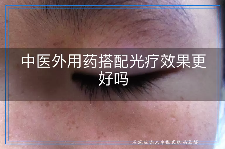 中医外用药搭配光疗效果更好吗
