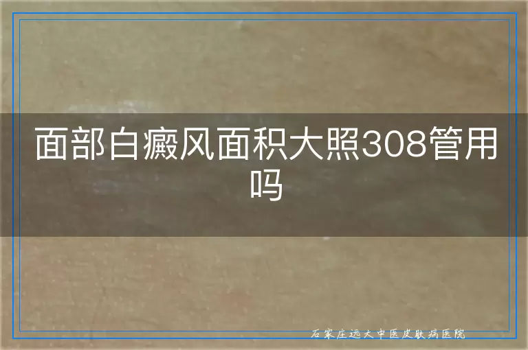 面部白癜风面积大照308管用吗