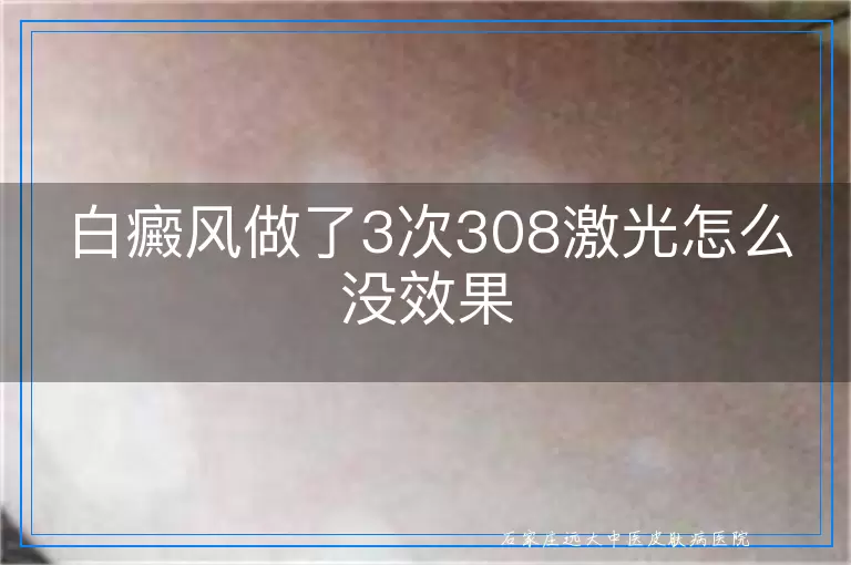 白癜风做了3次308激光怎么没效果