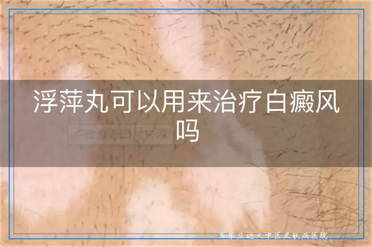 浮萍丸可以用来治疗白癜风吗