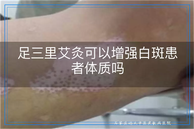 足三里艾灸可以增强白斑患者体质吗