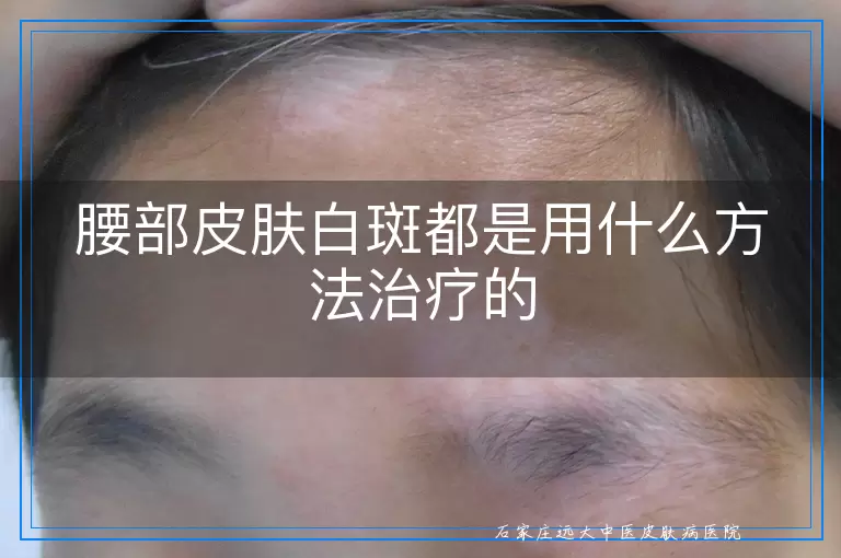 腰部皮肤白斑都是用什么方法治疗的
