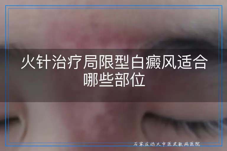 火针治疗局限型白癜风适合哪些部位