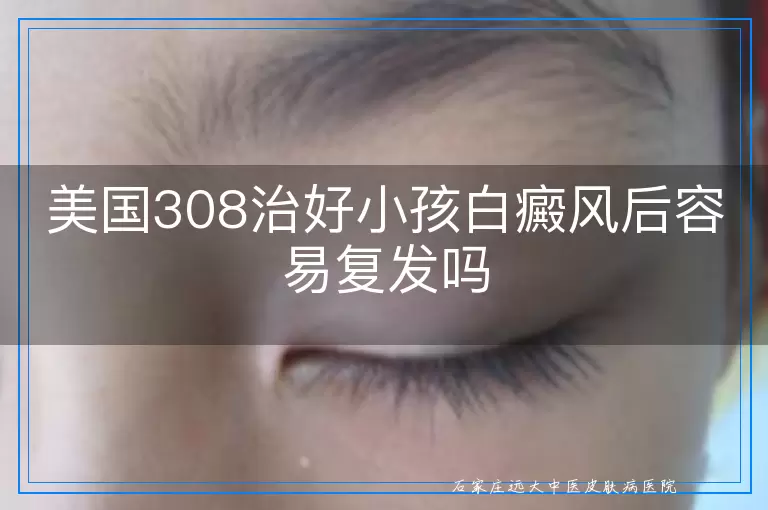 美国308治好小孩白癜风后容易复发吗