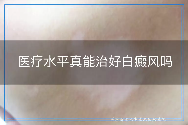 医疗水平真能治好白癜风吗
