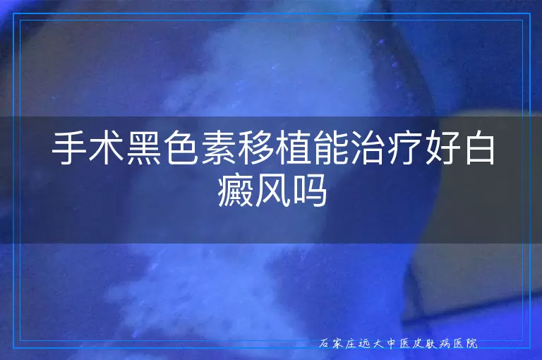 手术黑色素移植能治疗好白癜风吗