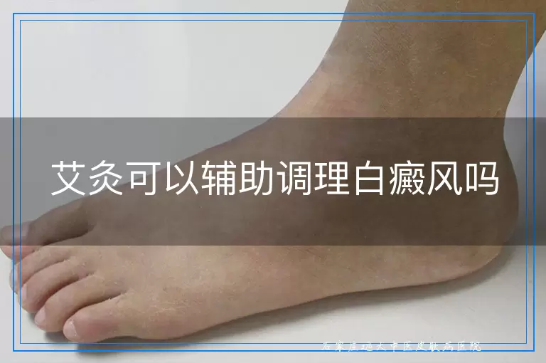 艾灸可以辅助调理白癜风吗
