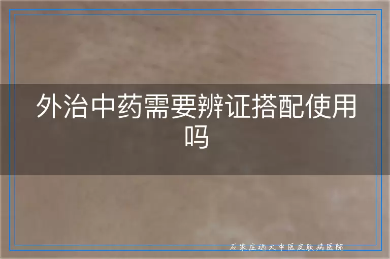外治中药需要辨证搭配使用吗