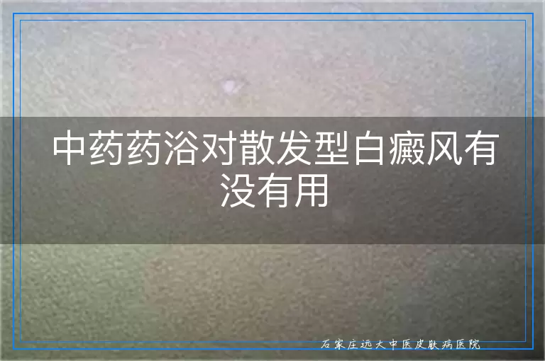 中药药浴对散发型白癜风有没有用
