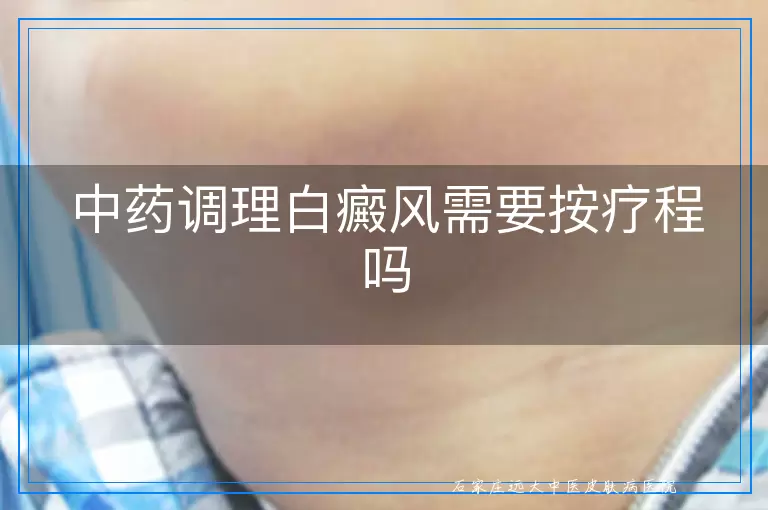 中药调理白癜风需要按疗程吗