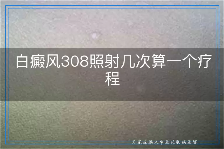 白癜风308照射几次算一个疗程