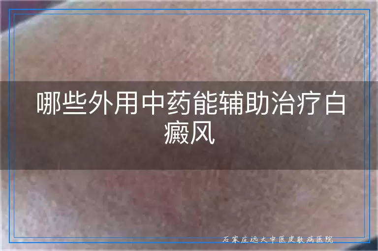 哪些外用中药能辅助治疗白癜风