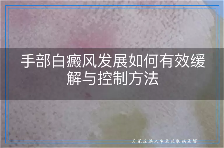 手部白癜风发展如何有效缓解与控制方法