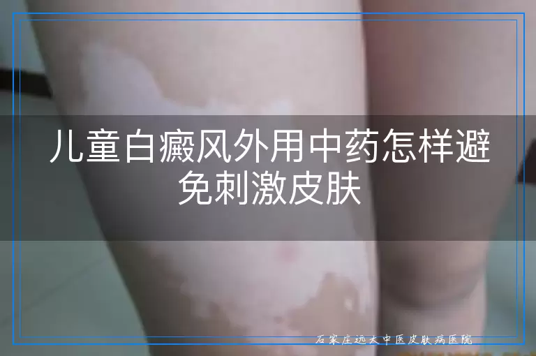 儿童白癜风外用中药怎样避免刺激皮肤