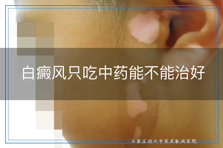 白癜风只吃中药能不能治好