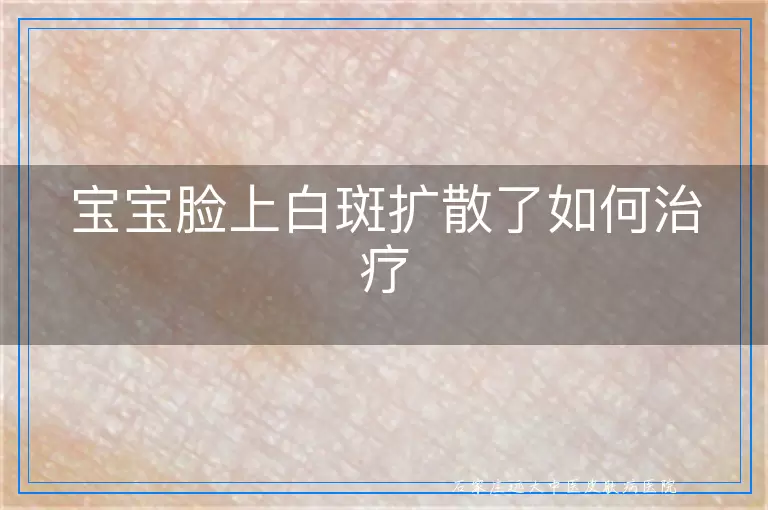 宝宝脸上白斑扩散了如何治疗