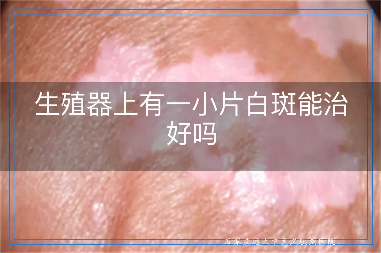 生殖器上有一小片白斑能治好吗