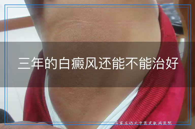 三年的白癜风还能不能治好