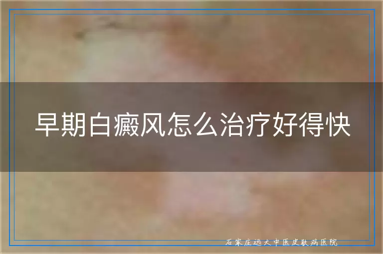 早期白癜风怎么治疗好得快