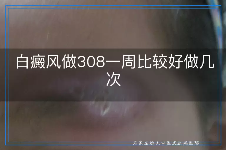 白癜风做308一周比较好做几次