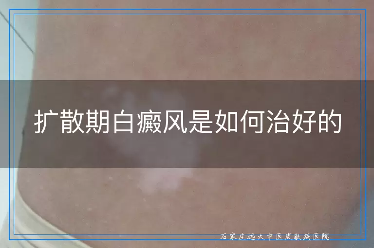 扩散期白癜风是如何治好的