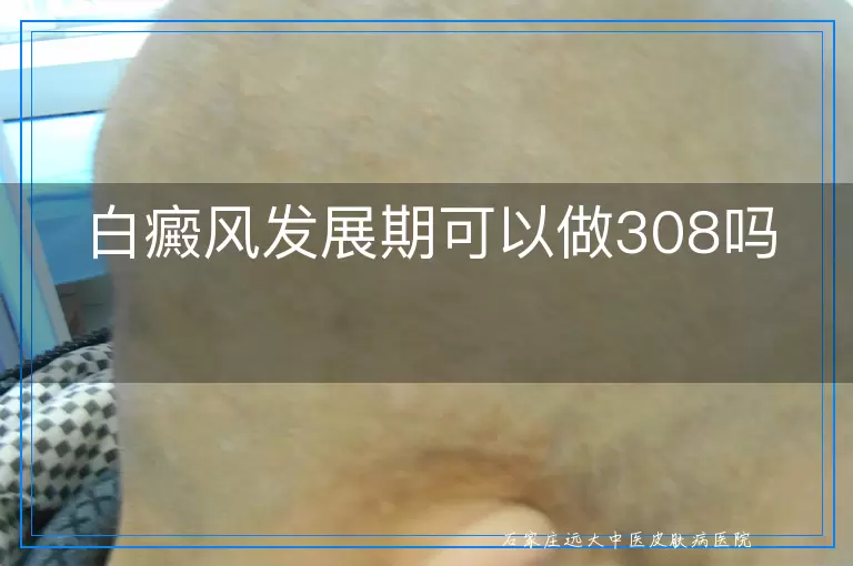 白癜风发展期可以做308吗