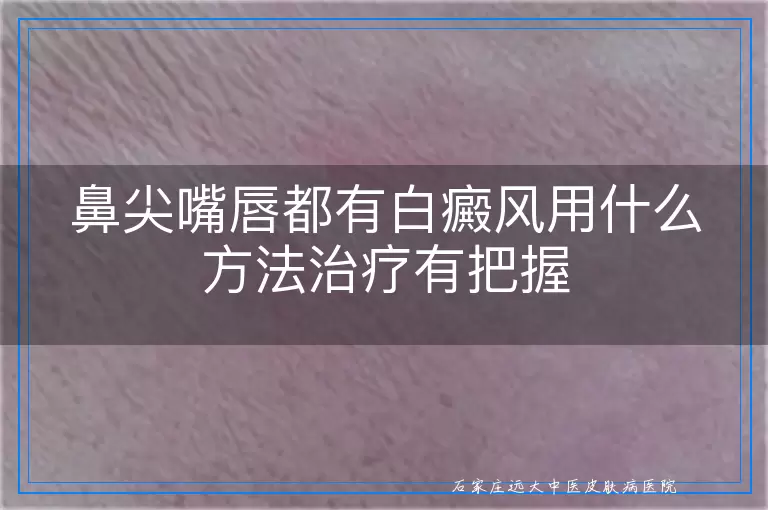 鼻尖嘴唇都有白癜风用什么方法治疗有把握