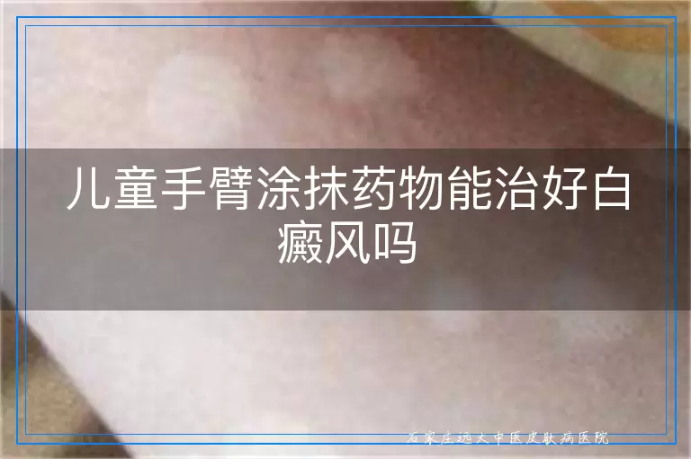 儿童手臂涂抹药物能治好白癜风吗