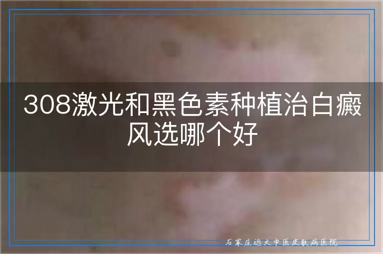 308激光和黑色素种植治白癜风选哪个好