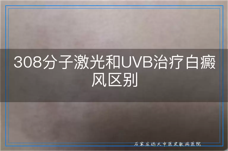 308分子激光和UVB治疗白癜风区别
