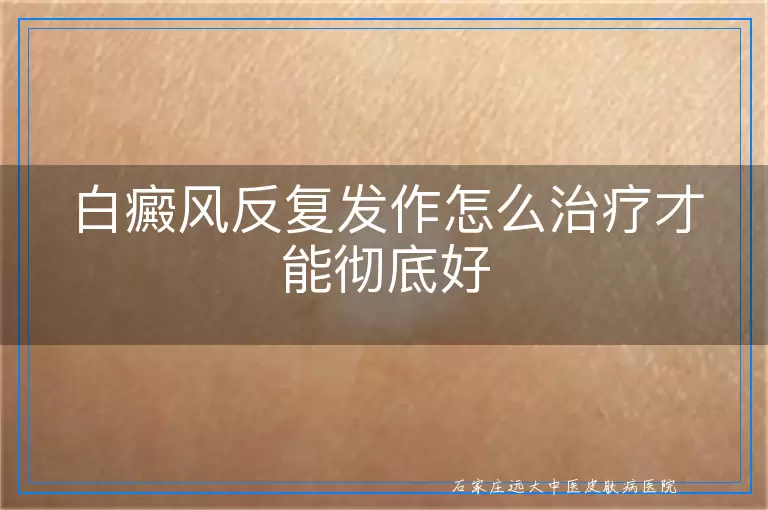 白癜风反复发作怎么治疗才能彻底好