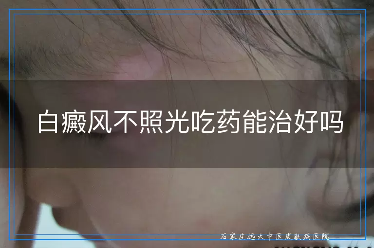 白癜风不照光吃药能治好吗