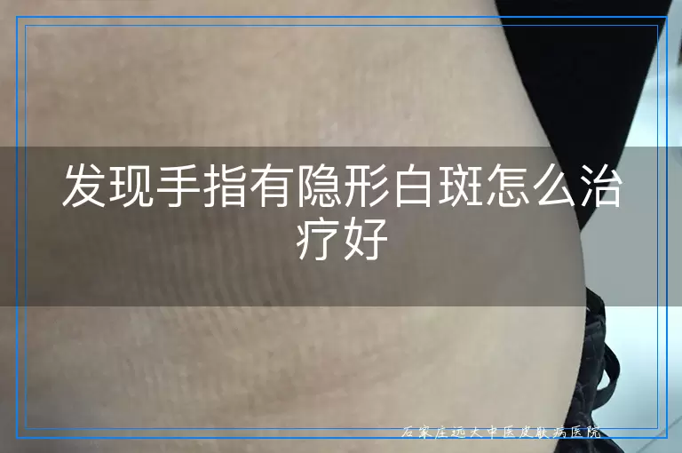 发现手指有隐形白斑怎么治疗好