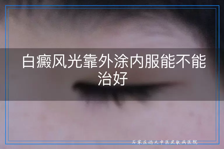 白癜风光靠外涂内服能不能治好