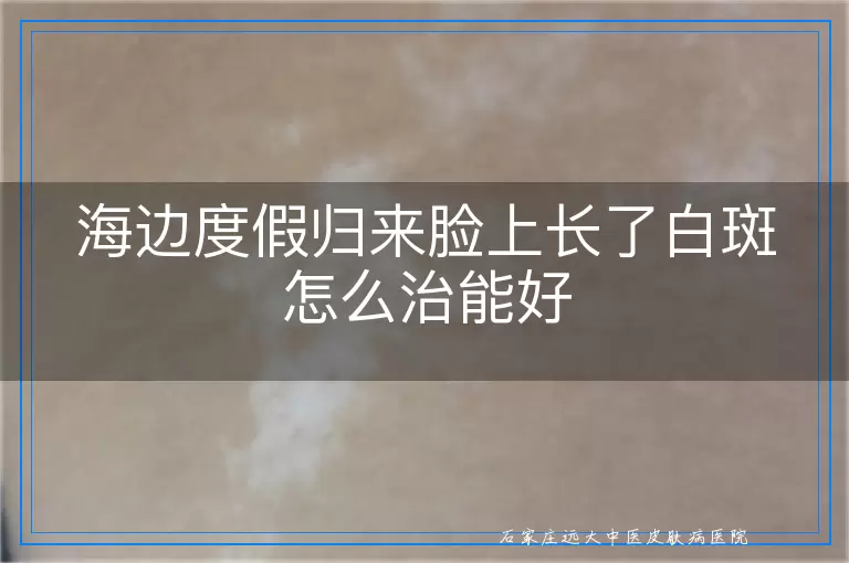 海边度假归来脸上长了白斑怎么治能好