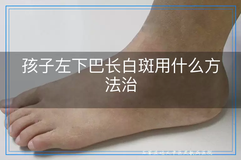 孩子左下巴长白斑用什么方法治