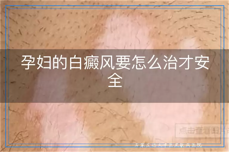 孕妇的白癜风要怎么治才安全