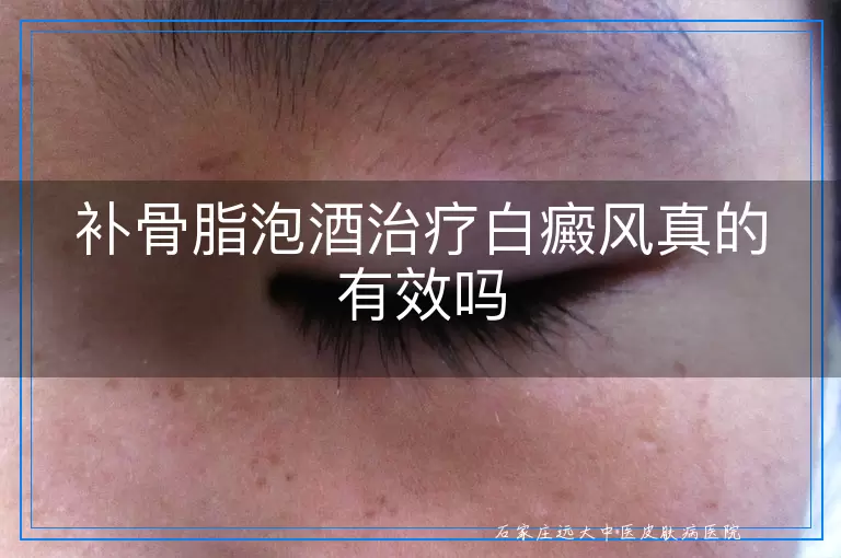 补骨脂泡酒治疗白癜风真的有效吗