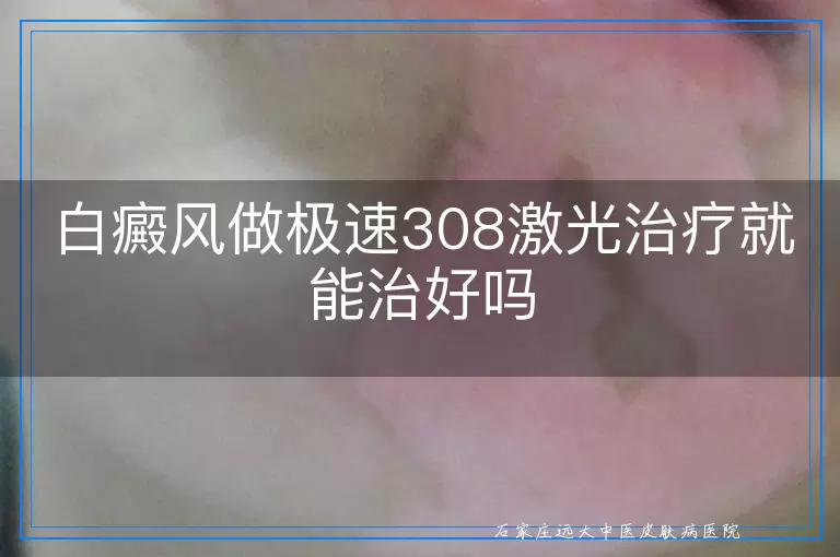 白癜风做极速308激光治疗就能治好吗