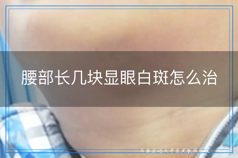 腰部长几块显眼白斑怎么治