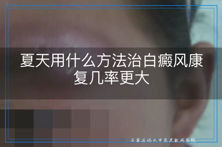 夏天用什么方法治白癜风康复几率更大