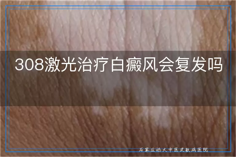 308激光治疗白癜风会复发吗