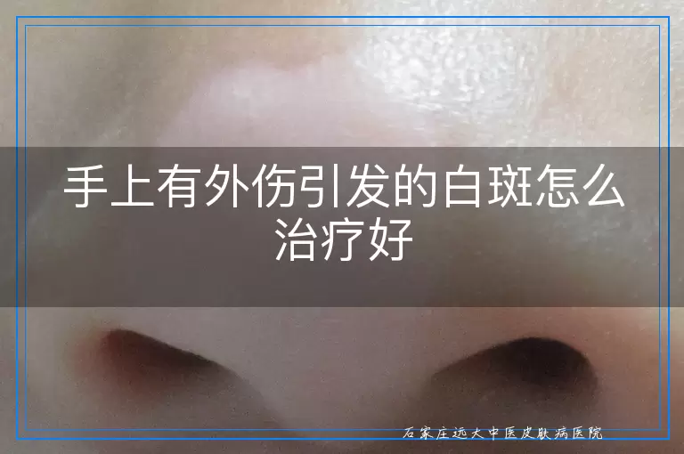 手上有外伤引发的白斑怎么治疗好