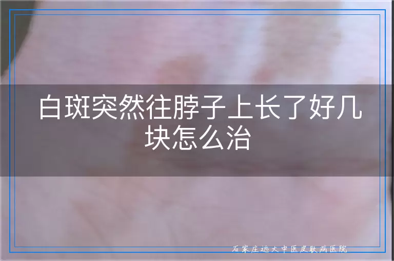 白斑突然往脖子上长了好几块怎么治