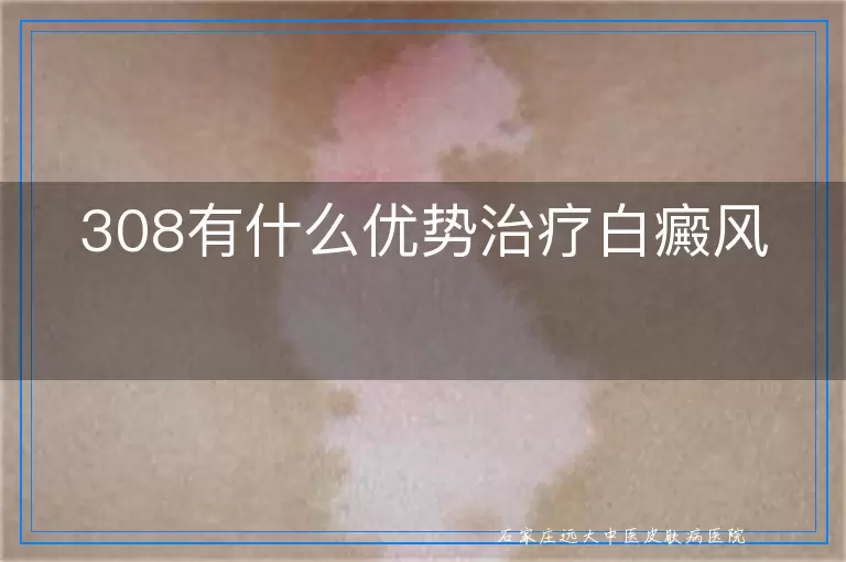 308有什么优势治疗白癜风