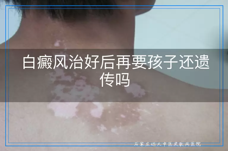 白癜风治好后再要孩子还遗传吗