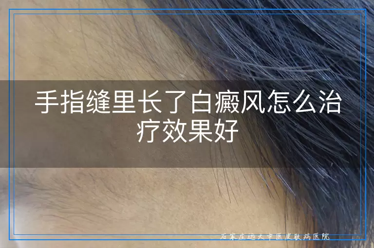 手指缝里长了白癜风怎么治疗效果好