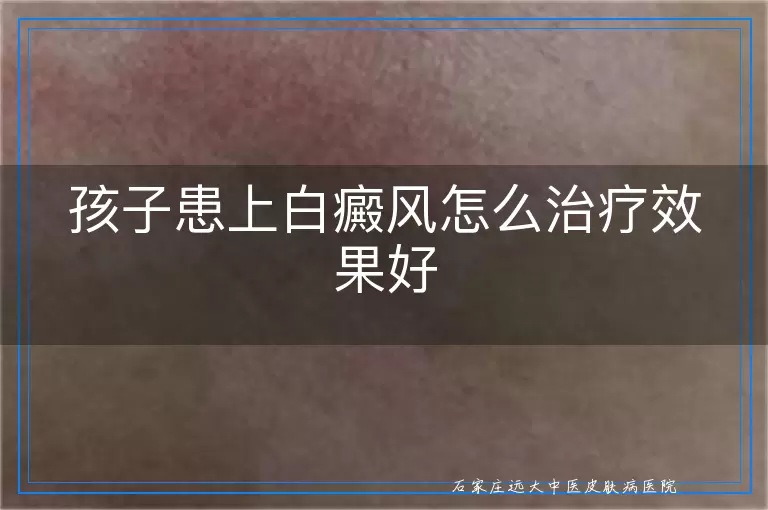 孩子患上白癜风怎么治疗效果好